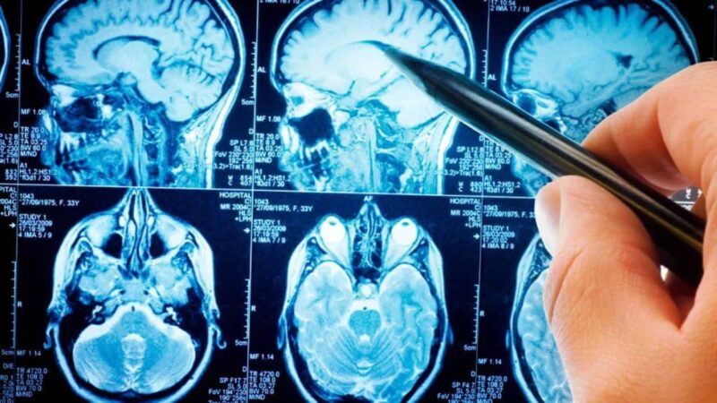 Ondas cerebrais durante o sono indicam risco aumentado de demência