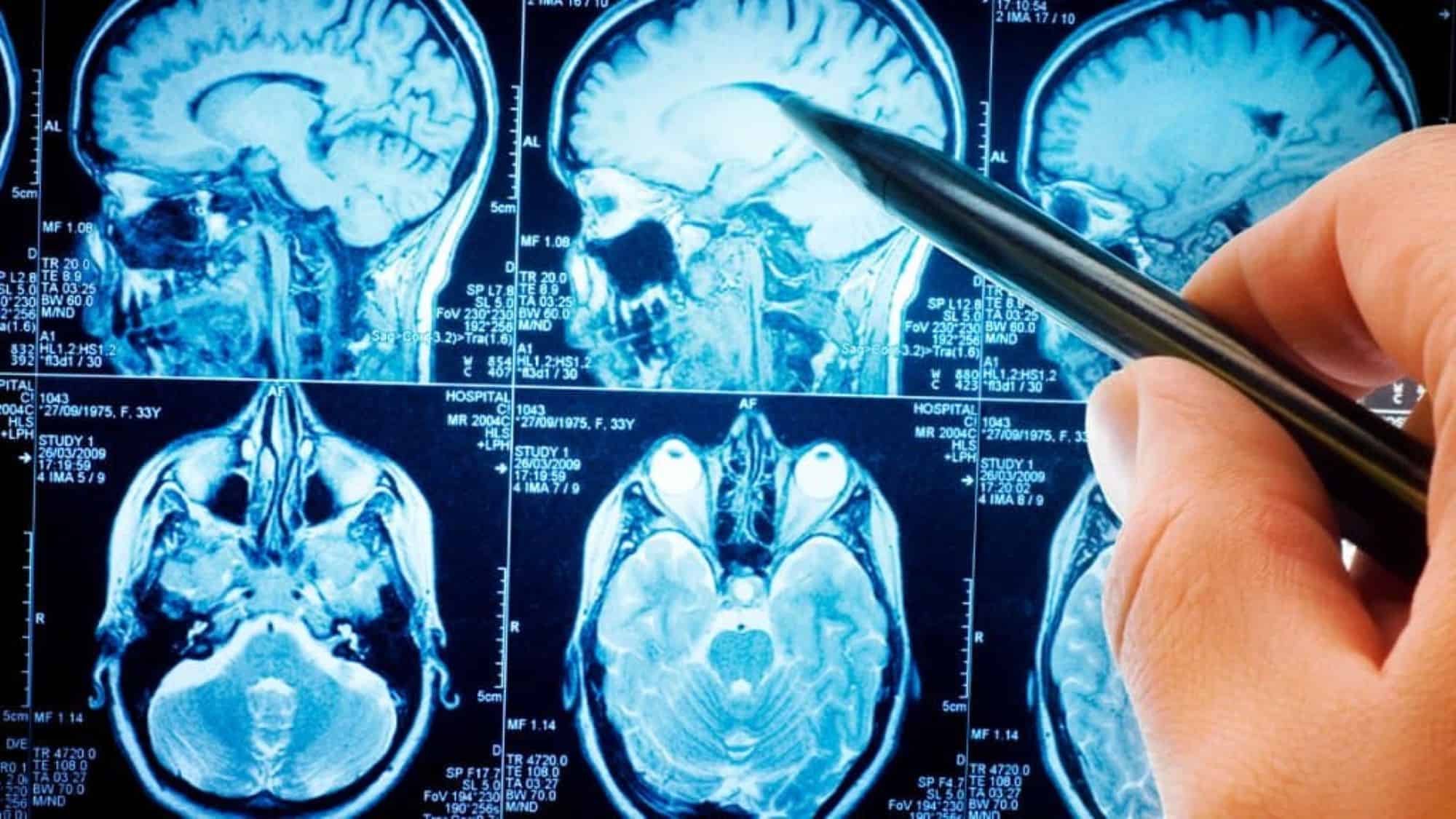 Ondas cerebrais durante o sono indicam risco aumentado de demência