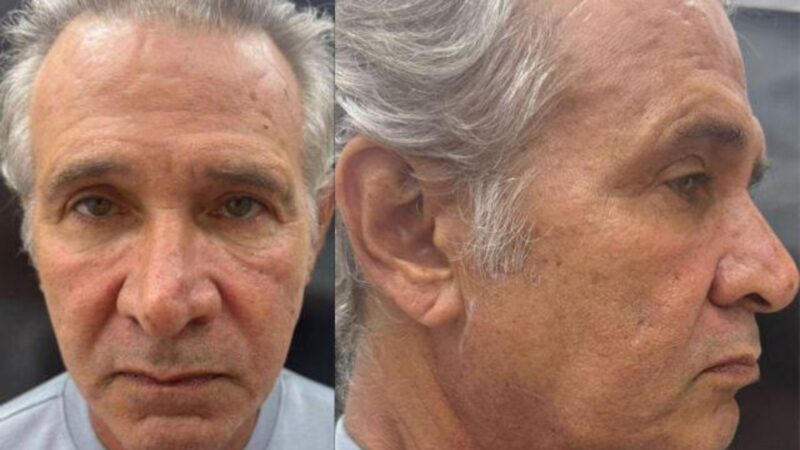 Nelson Freitas exibe resultado de harmonização facial em programa do SBT
