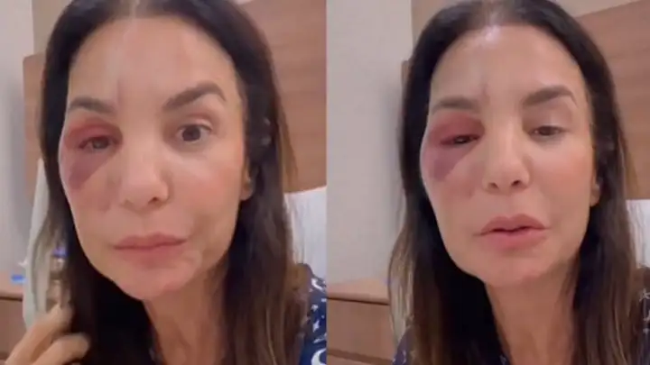 Ivete Sangalo passa por cirurgia e aparece com o rosto inchado após queda em Salvador