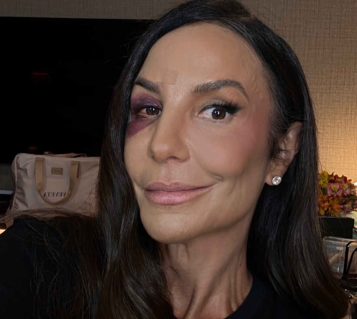 Ivete Sangalo atualiza fãs após cirurgia e mostra rosto inchado: “Tá bonito? Não tá bonito”
