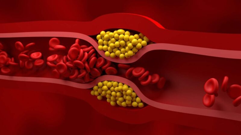 Edição genética por infusão única reduz LDL em até 62% e pode transformar prevenção cardíaca