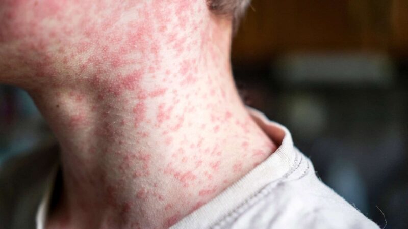 Autoridades de saúde vão reforçar vigilância durante a Copa para evitar surtos de doenças infecciosas