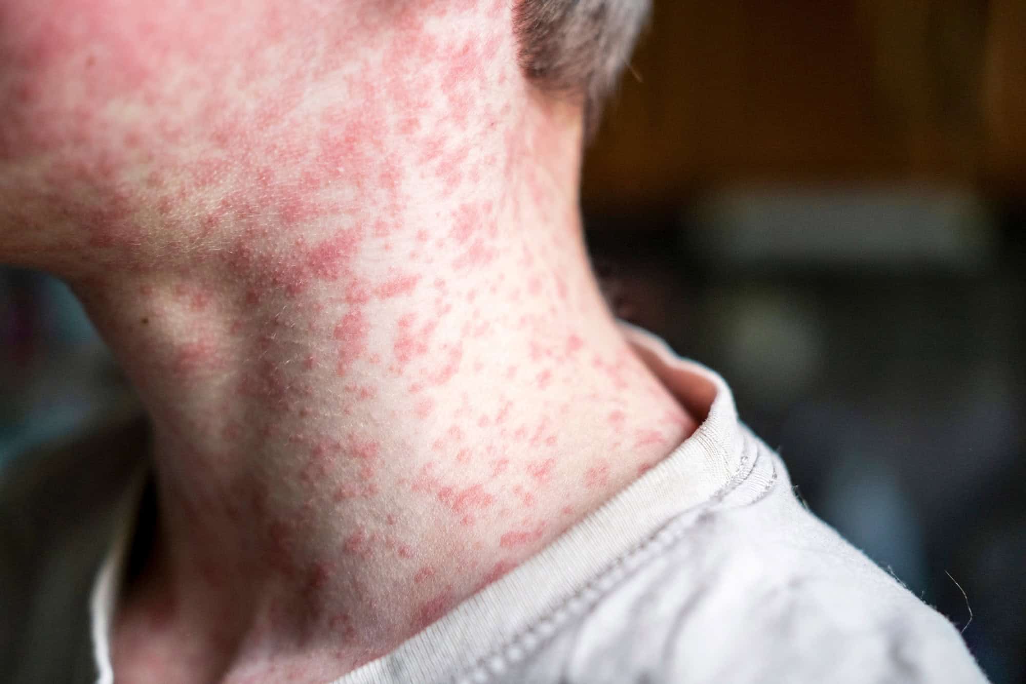 Autoridades de saúde vão reforçar vigilância durante a Copa para evitar surtos de doenças infecciosas